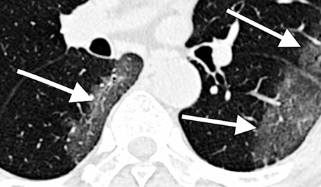 Tell-tale signs: CT scan of lungs of Covid-19 patient.