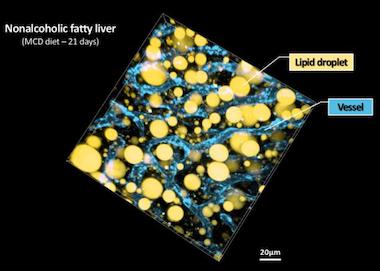 Disease progression: NAFLD