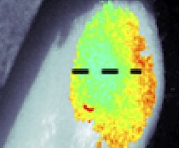 Margin call: tumor depth