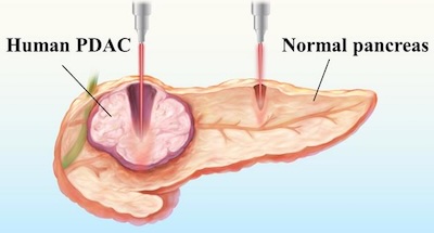 On the right wavelength: targeted treatment