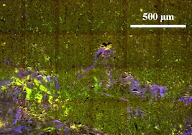 Multiphoton microscopy and deep learning: tumor detection