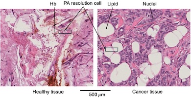 Critical differences: lipids and hemoglobin