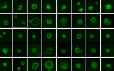 Non-linear imaging: plaques observed