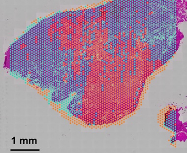 Signs of disease: phenotyping cancer