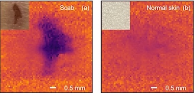 In vivo THz real-time imaging of scab on wound