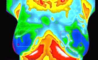 Infrared scanning for breast cancer: now worthy of wider adoption