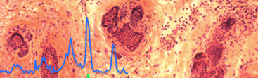 A spectroscopic fingerprint of potentially cancerous tissue layers.