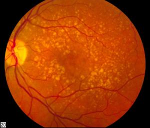 Age-related macular degeneration