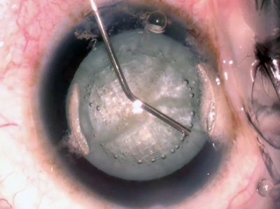 Going... Catalys treatment of cataract begins