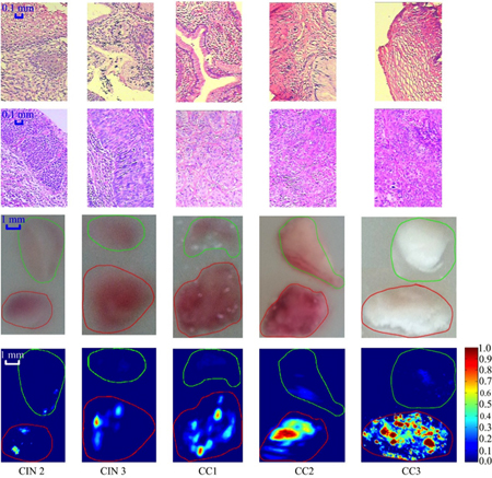 Comparison between the normal cervical tissue and tissue lesion for different stages.
