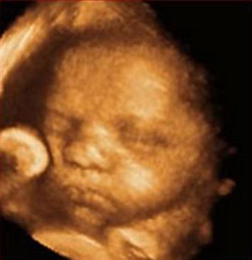 Reduced risk of disability in affected twin fetuses.