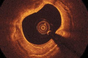 Inside a blood vessel