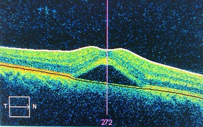 CSR diagnosis using optical coherence tomography