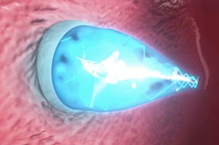 Tissue repair: the UV-cured patch