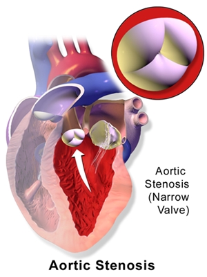 Aortic stenosis