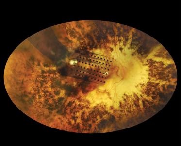 Retinal implant