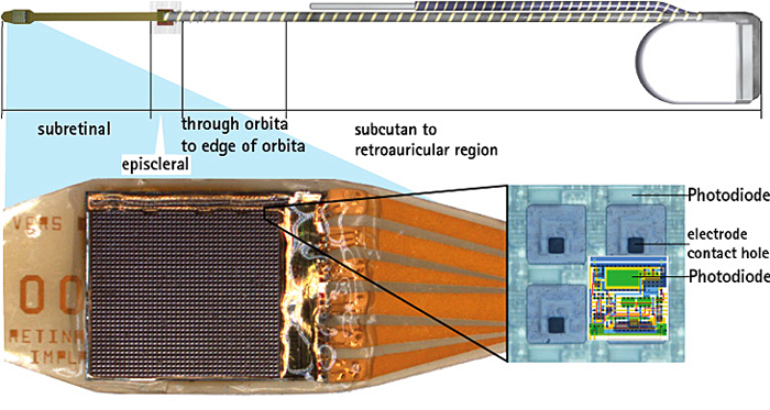The Alpha-IMS device developed by Retina Implant comprises 1500 photodiodes. 