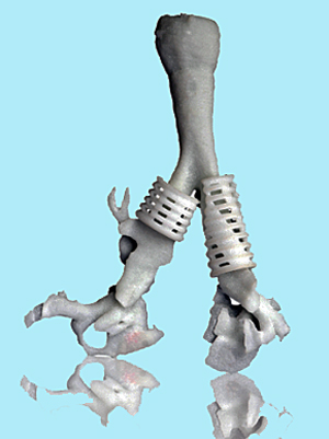 Two of Michigan's groundbreaking 3D printed tracheal splints.