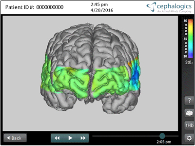 Cephalogics' approach eliminates obscuring effects of biological tissues around the brain.
