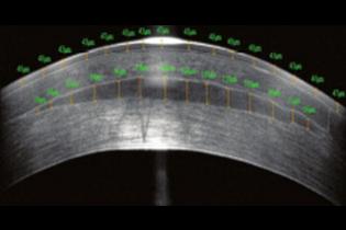 Clear vision: implants from donor corneas