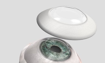 CorNeat Kpro: better biocompatibility