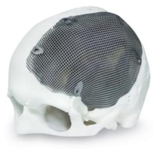 AM implants: made to measure