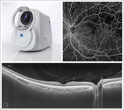 Eye resolution: Zeiss Plex Elite 9000 Swept-Source OCT and retina images.