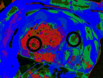 Hyperspectral data: tumor margins revealed