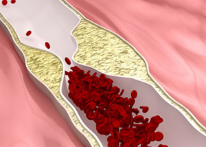 Peripheral Artery Disease.