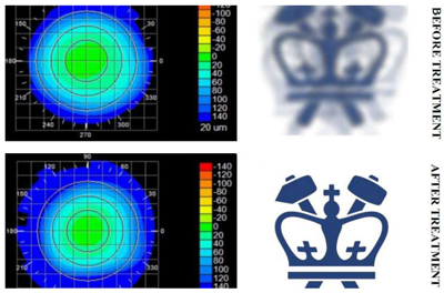 Eyes right: Corneal topography before and after the treatment.
